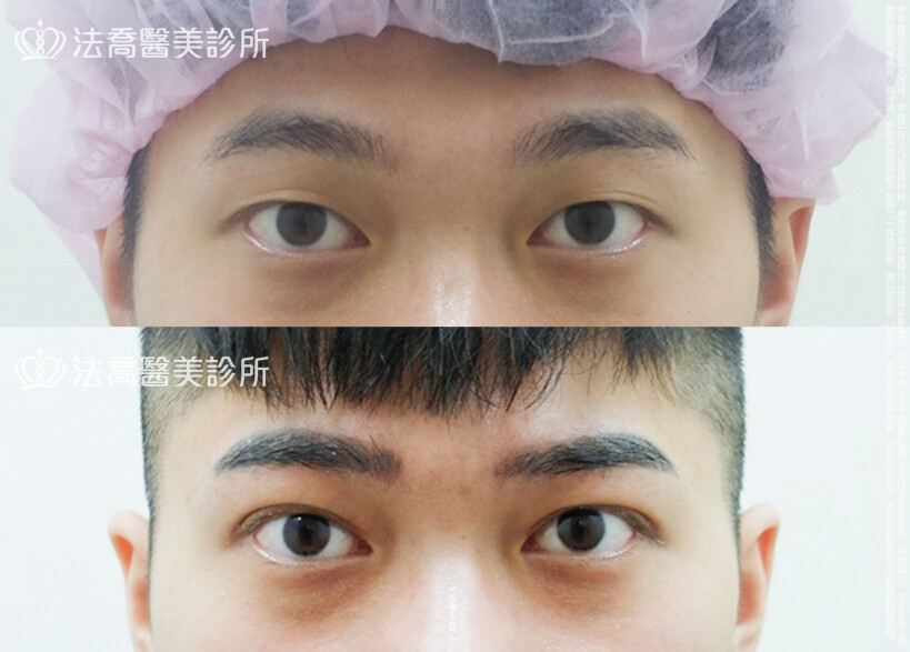 割雙眼皮