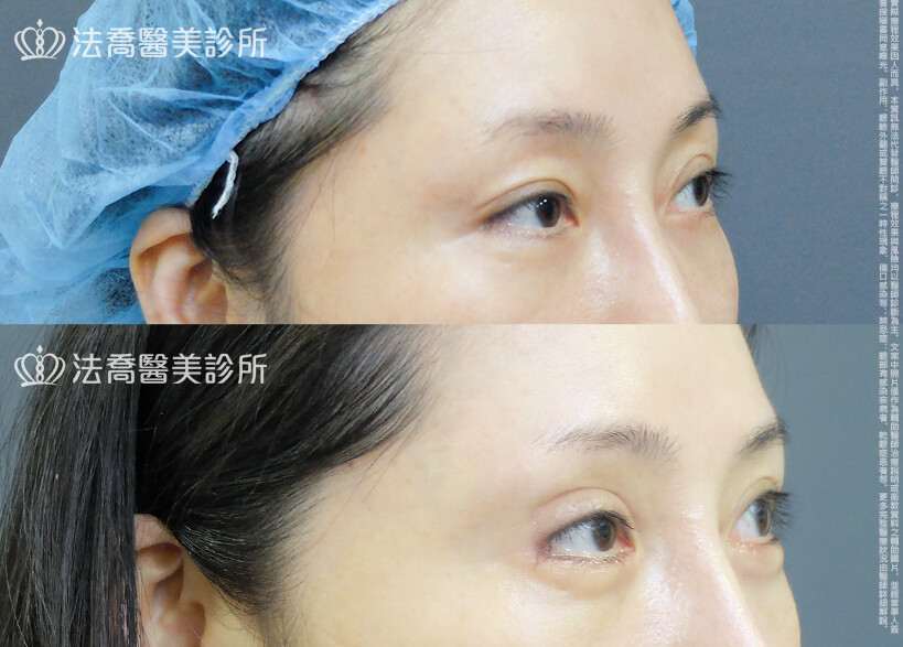 割雙眼皮
