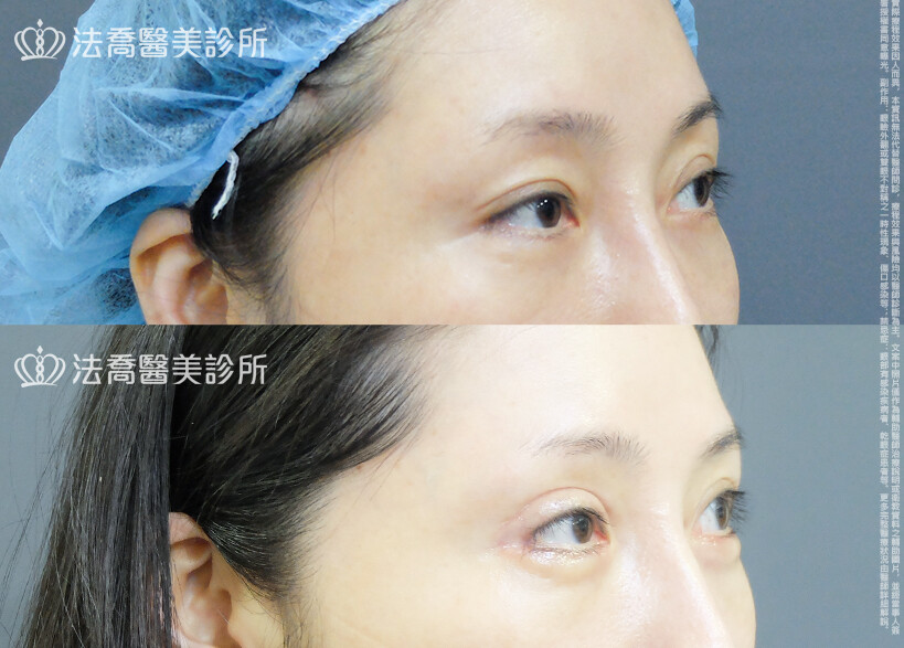 眼瞼肌提拉術  