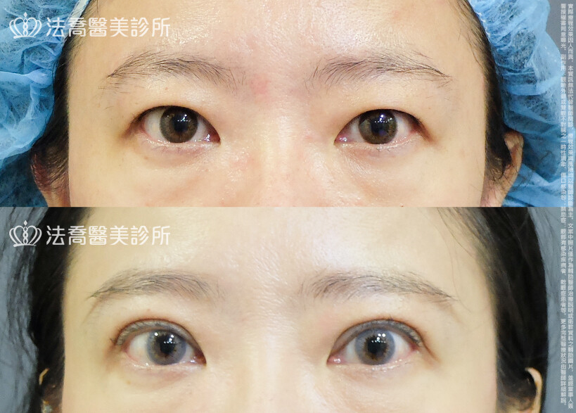 割雙眼皮