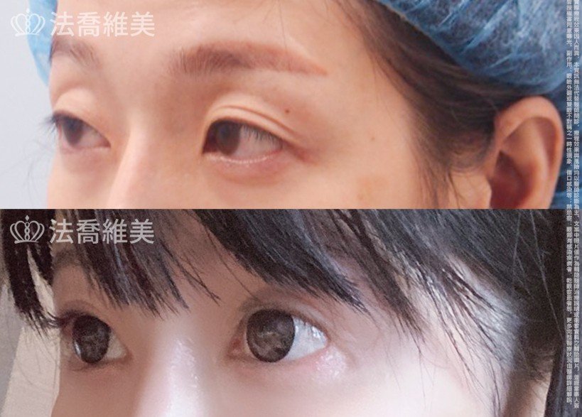 割雙眼皮