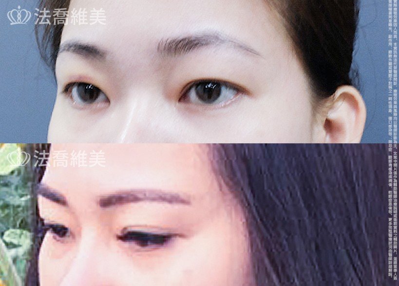 割雙眼皮