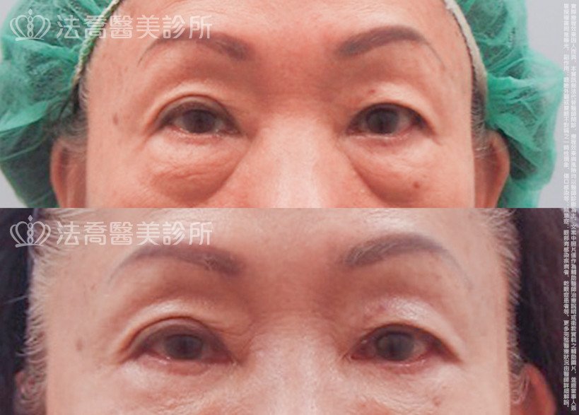 法喬醫美診所邱浚彥醫師眼袋外開