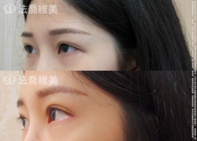 法喬醫美診所,邱浚彥,割雙眼皮,眼袋內開