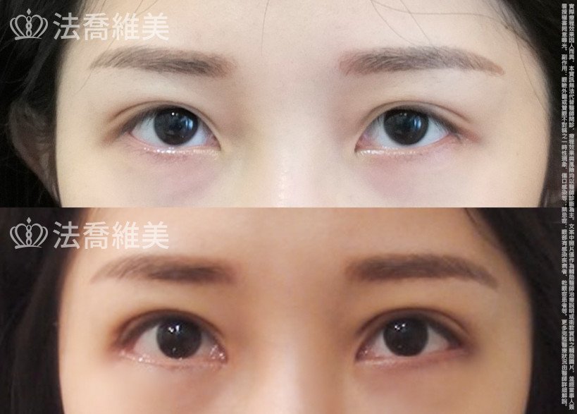 法喬醫美診所,邱浚彥,眼袋內開