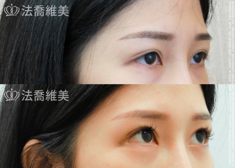 法喬醫美診所,邱浚彥,眼袋內開