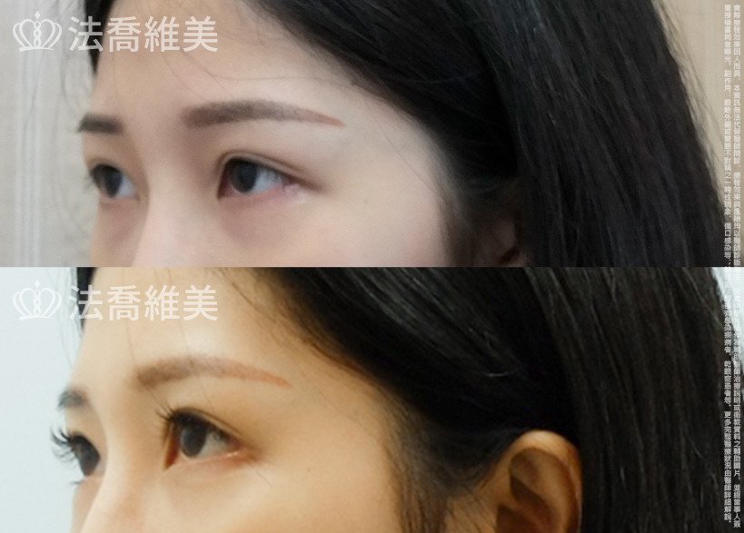 法喬醫美診所,邱浚彥,眼袋內開