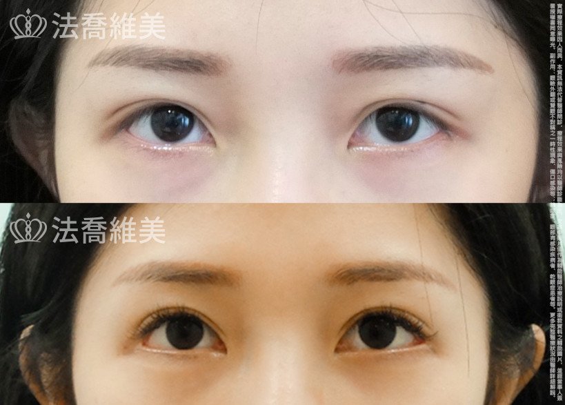 法喬醫美診所,邱浚彥,眼袋內開