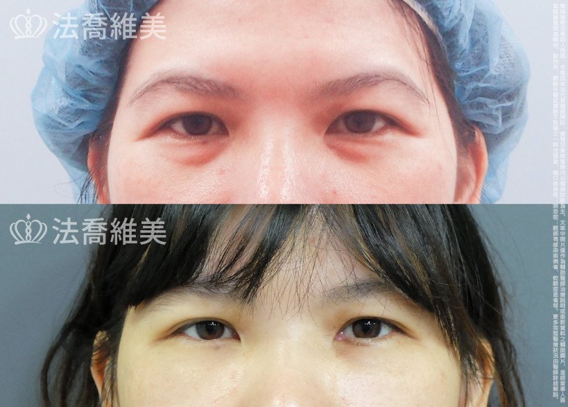 法喬醫美診所,邱浚彥,眼袋內開