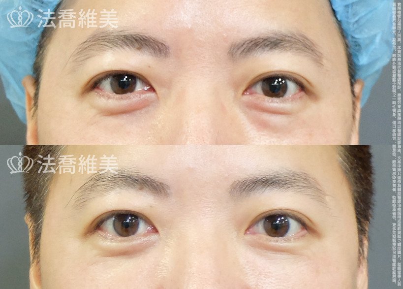 法喬醫美診所 邱浚彥醫師,眼袋內開