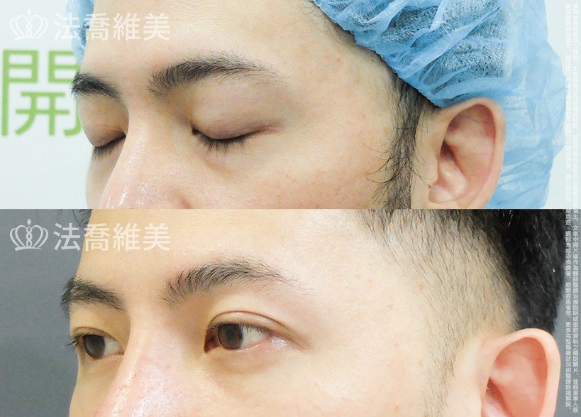 法喬醫美診所 邱浚彥醫師,眼袋內開
