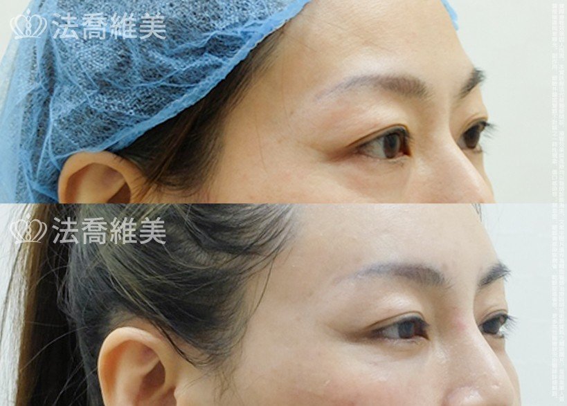 法喬醫美診所 邱浚彥醫師,眼袋內開
