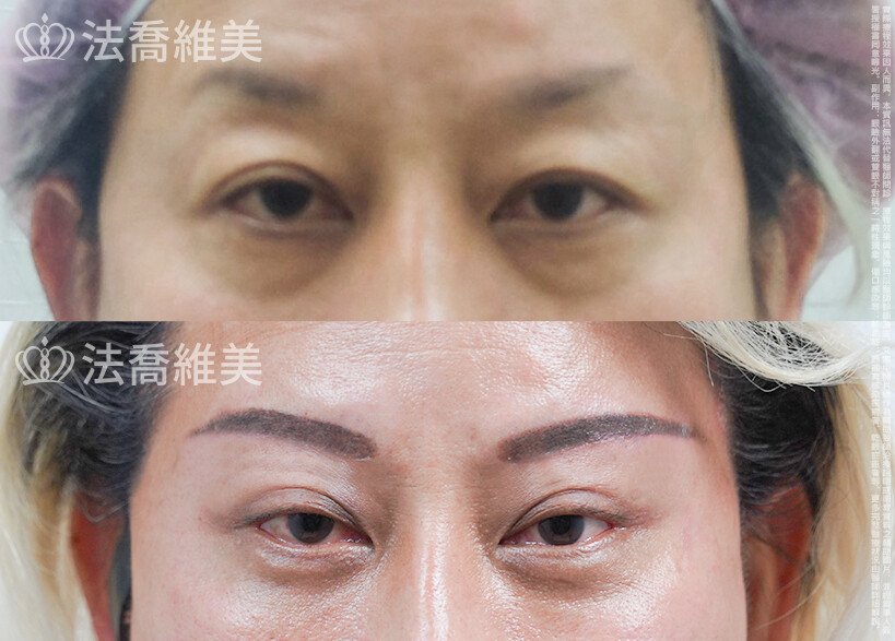 法喬醫美診所 邱浚彥醫師,眼袋內開
