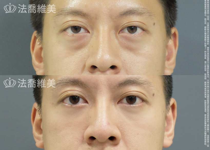 眼袋內開+補蘋果肌