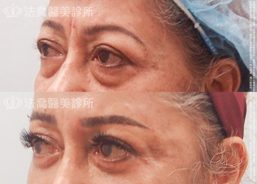 法喬醫美診所,邱浚彥,切眉