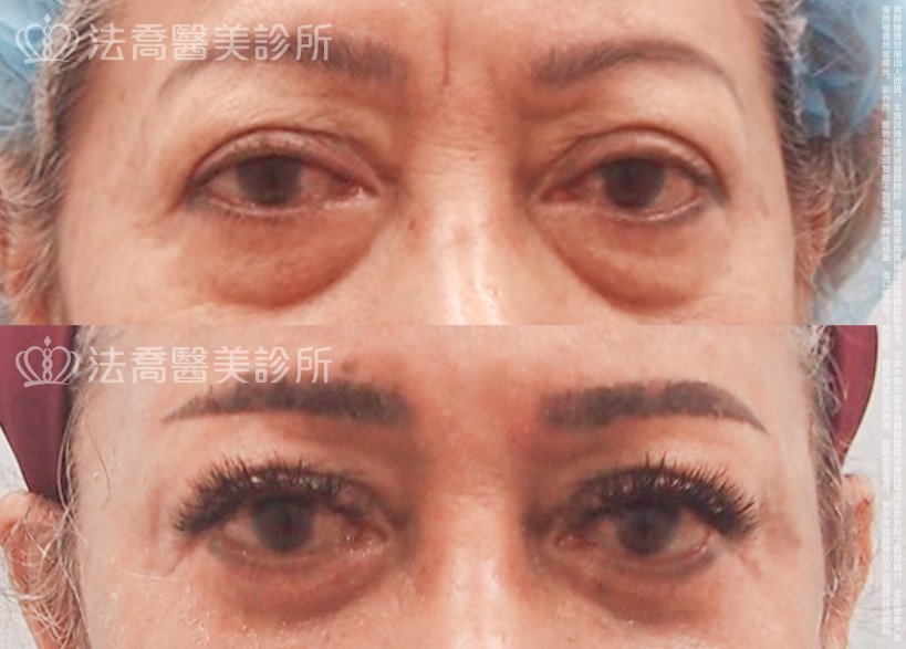 法喬醫美診所,邱浚彥,切眉