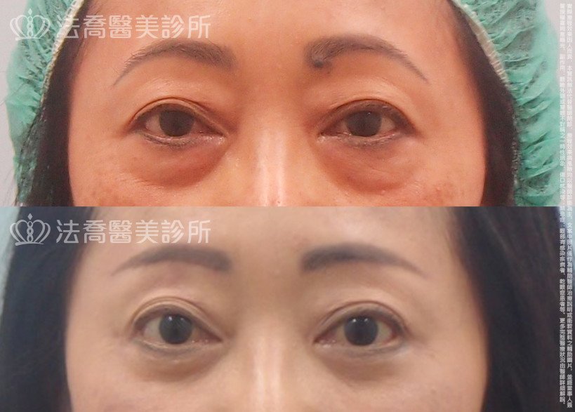 法喬醫美診所,邱浚彥,眼袋外開,切眉