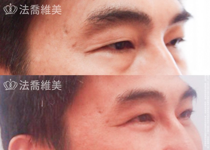 法喬醫美診所,邱浚彥醫師,眼袋外開