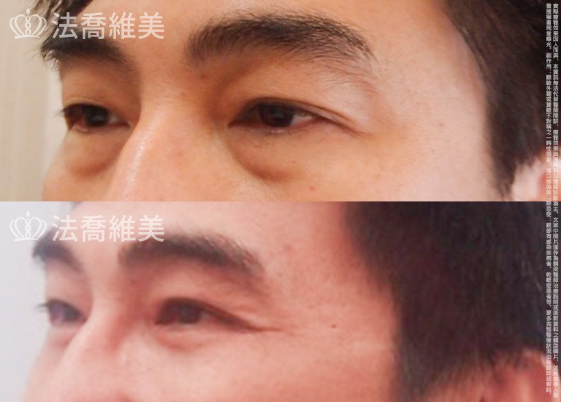 法喬醫美診所,邱浚彥醫師,眼袋外開