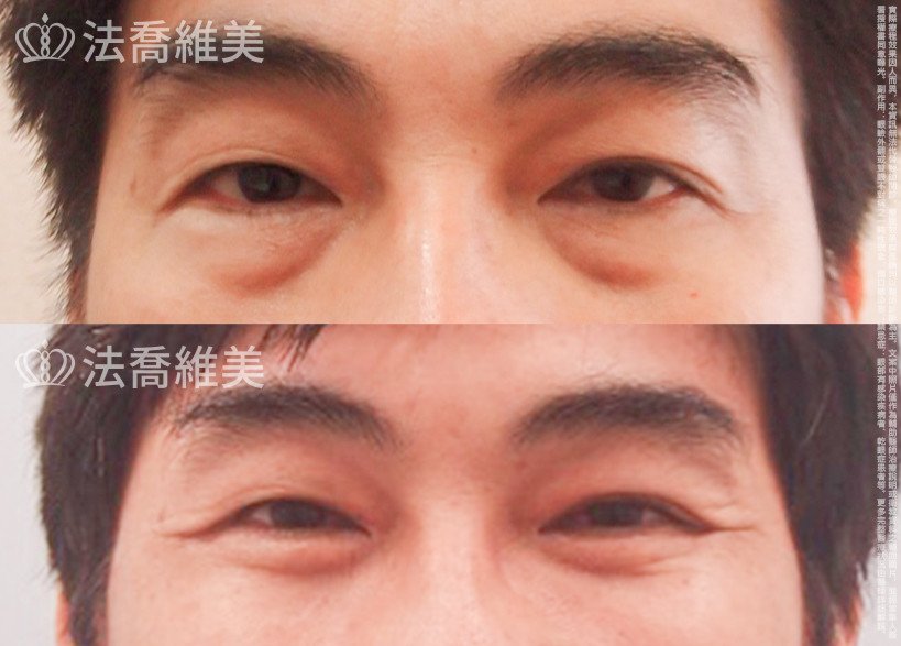 法喬醫美診所,邱浚彥醫師,眼袋外開