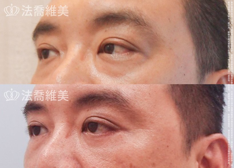 法喬醫美診所,邱浚彥醫師,眼袋外開