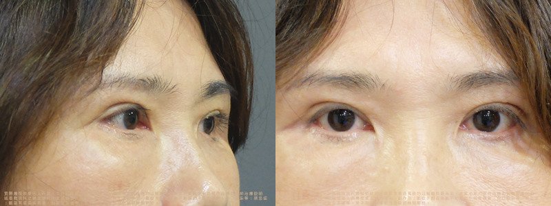 邱浚彥醫師眼袋案例_切眉+眼袋外開脂肪移位