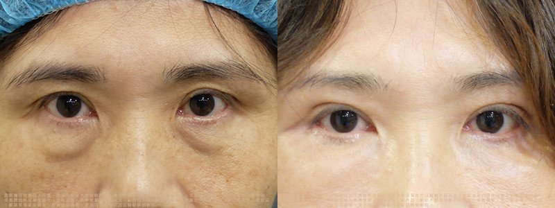 邱浚彥醫師眼袋案例_切眉+眼袋外開脂肪移位