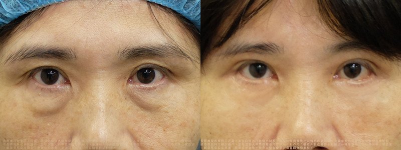 邱浚彥醫師眼袋案例_切眉+眼袋外開脂肪移位