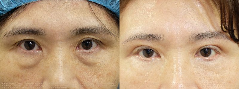 邱浚彥醫師眼袋案例_切眉+眼袋外開脂肪移位