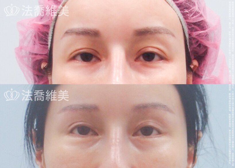 眼部手術