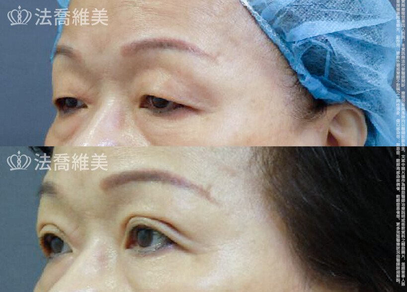 法喬醫美診所 邱浚彥醫師,縫雙眼皮
