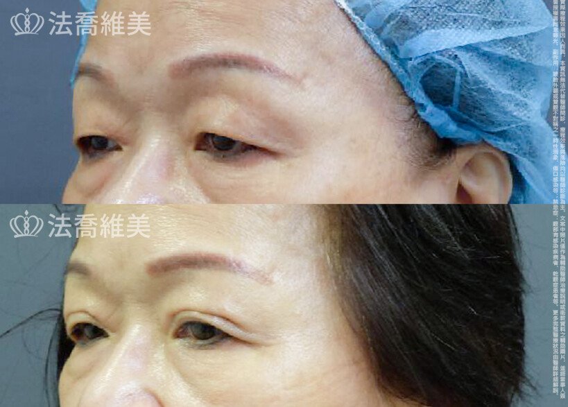 法喬醫美診所 邱浚彥醫師,縫雙眼皮