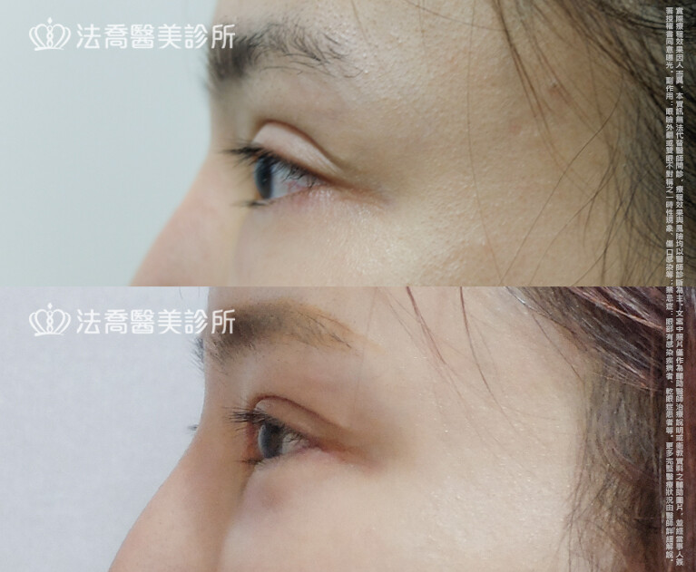 法喬醫美診所,邱浚彥,自體脂肪豐臉,割雙眼皮,眼窩補脂