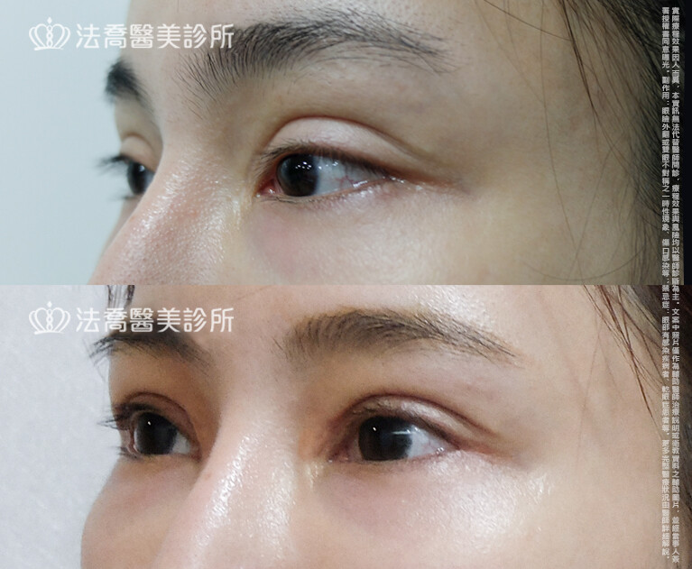 法喬醫美診所,邱浚彥,自體脂肪豐臉,割雙眼皮,眼窩補脂