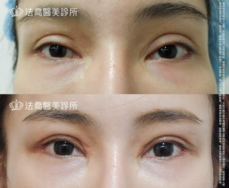 法喬醫美診所,邱浚彥,自體脂肪豐臉,割雙眼皮,眼窩補脂