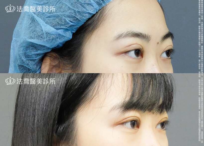 雙眼皮重修
