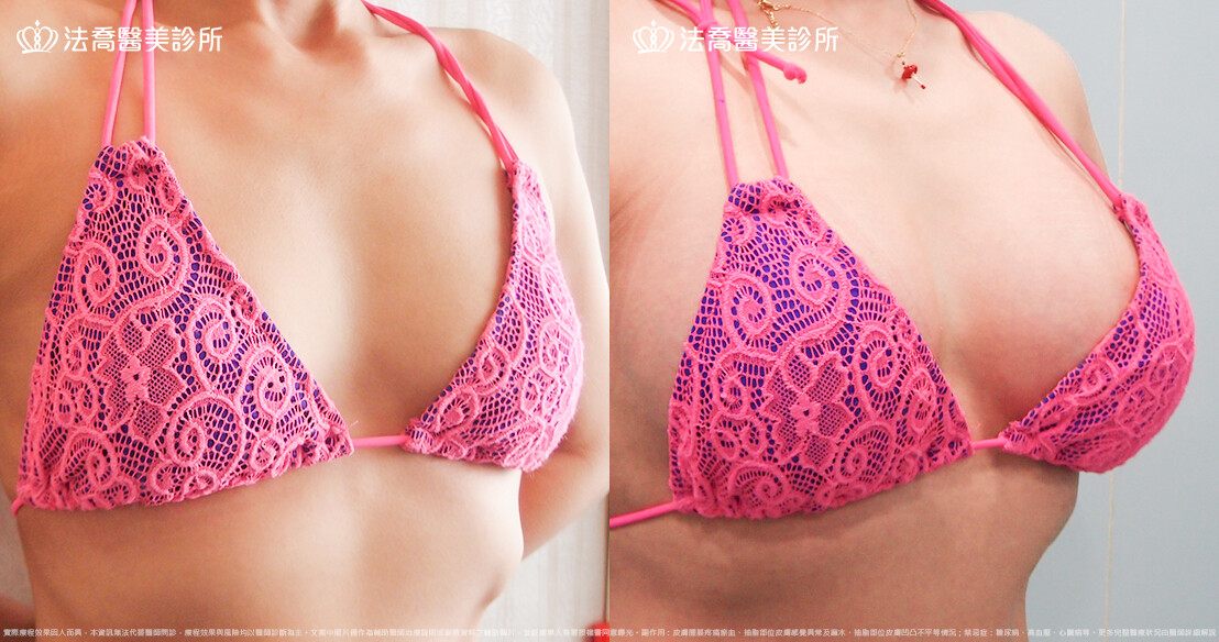 法喬醫美診所 邱浚彥醫師,複合式果凍矽膠隆乳