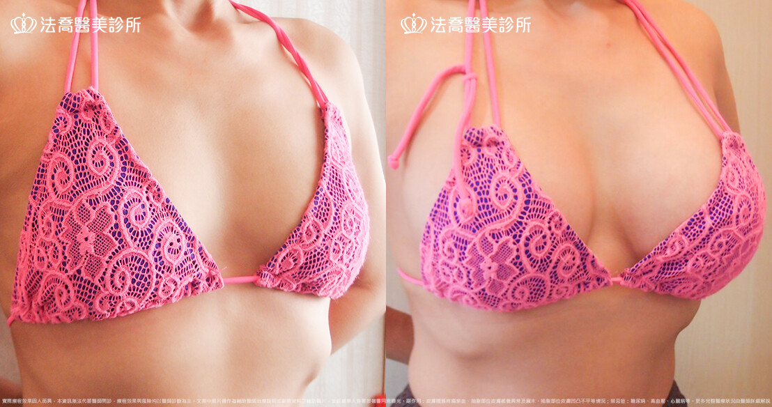 法喬醫美診所 邱浚彥醫師,複合式果凍矽膠隆乳