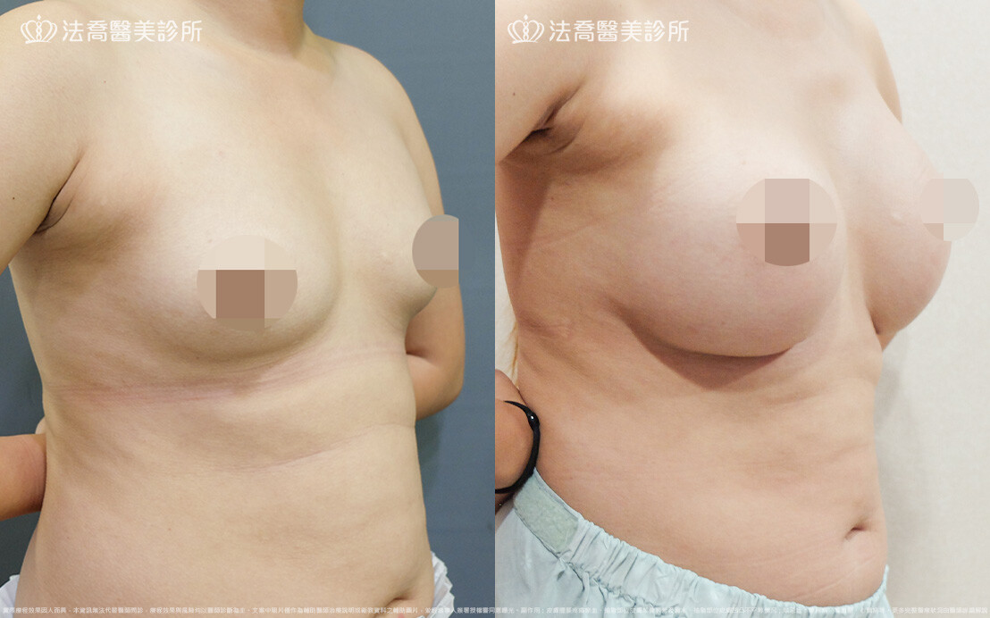 法喬醫美診所,邱浚彥,圓盤果凍矽膠隆乳