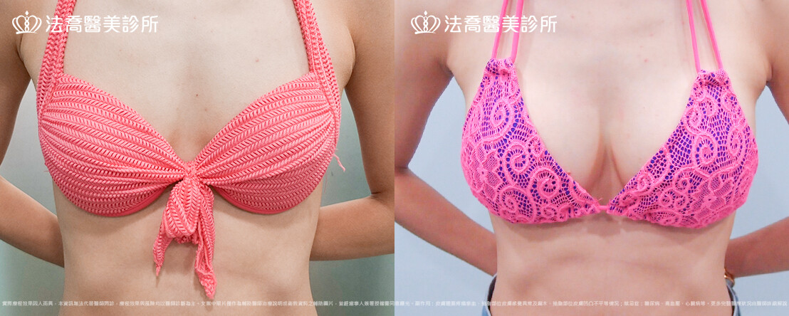 水滴型隆乳