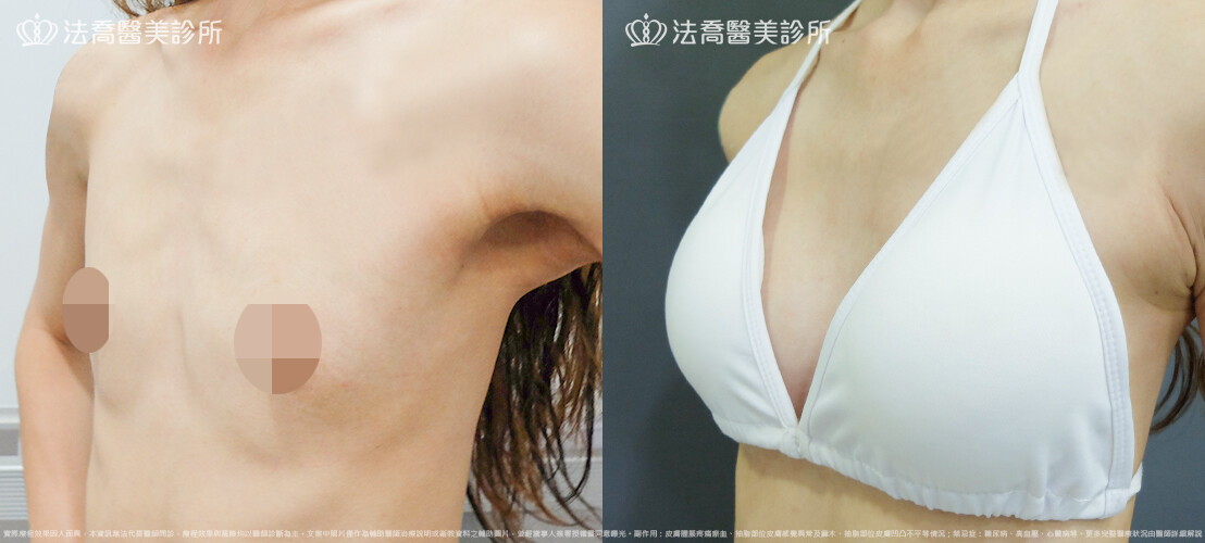 法喬醫美診所,邱浚彥,圓盤果凍矽膠隆乳