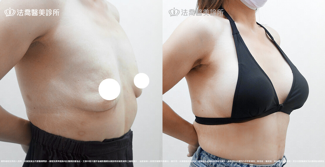 隆乳