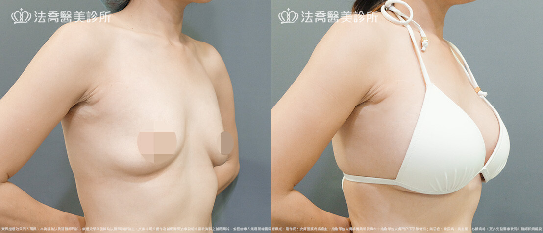 法喬醫美診所,邱浚彥,圓盤果凍矽膠隆乳