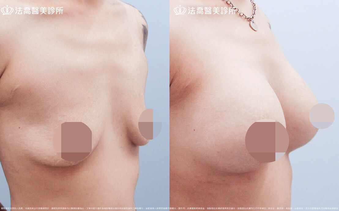 法喬醫美診所,邱浚彥,圓盤果凍矽膠隆乳