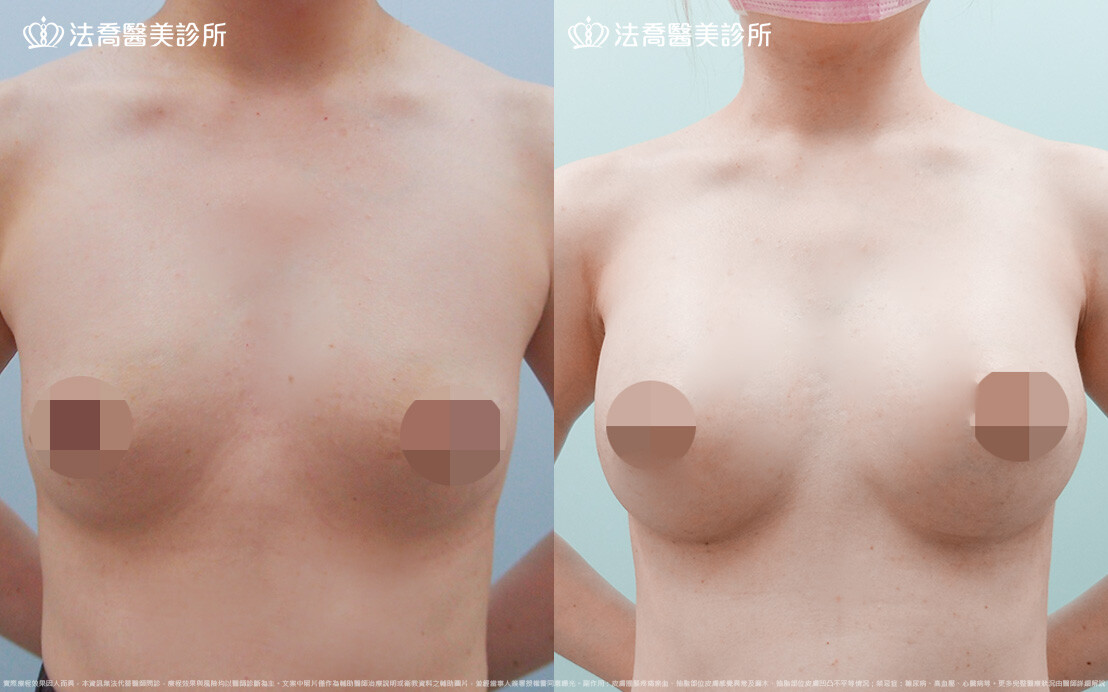 法喬醫美診所,邱浚彥,圓盤果凍矽膠隆乳