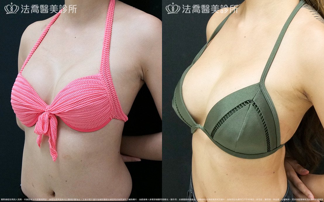 法喬醫美診所,邱浚彥,水滴果凍隆乳