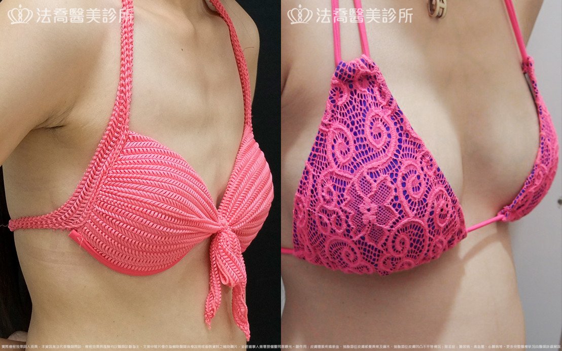 法喬醫美診所,邱浚彥,水滴果凍隆乳