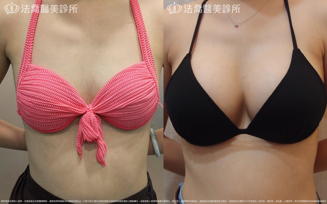 法喬醫美診所,邱浚彥,水滴果凍隆乳