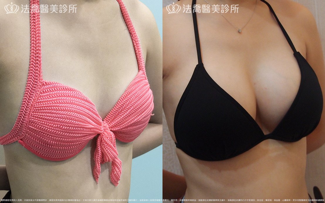 法喬醫美診所,邱浚彥,水滴果凍隆乳