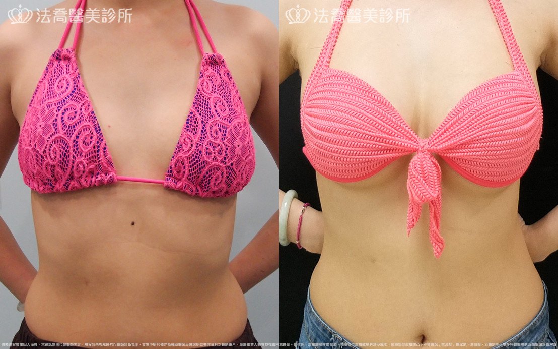 法喬醫美診所,邱浚彥,水滴果凍隆乳